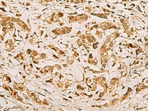 Immunohistochemistry of paraffin-embedded Human gastric cancer tissue using ZMAT4 Polyclonal Antibody at dilution of 1:65(×200)