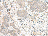 Immunohistochemistry of paraffin-embedded Human esophagus cancer tissue using FBXW8 Polyclonal Antibody at dilution of 1:70(×200)
