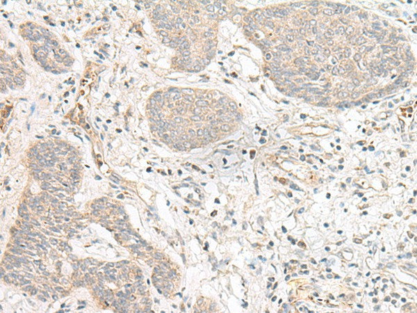 Immunohistochemistry of paraffin-embedded Human esophagus cancer tissue using FBXW8 Polyclonal Antibody at dilution of 1:70(×200)