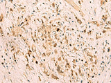 Immunohistochemistry of paraffin-embedded Human gastric cancer tissue using SGTA Polyclonal Antibody at dilution of 1:75(×200)
