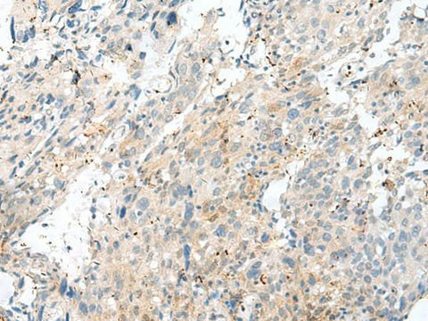 Immunohistochemistry of paraffin-embedded Human cervical cancer tissue using NXNL1 Polyclonal Antibody at dilution of 1:45(×200)