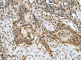 Immunohistochemistry of paraffin-embedded Human esophagus cancer tissue using PRPF40A Polyclonal Antibody at dilution of 1:60(×200)