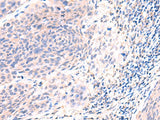 Immunohistochemistry of paraffin-embedded Human cervical cancer tissue using ESM1 Polyclonal Antibody at dilution of 1:50(×200)