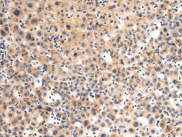 Immunohistochemistry of paraffin-embedded Human liver cancer tissue using GLT8D1 Polyclonal Antibody at dilution of 1:90(×200)