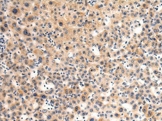 Immunohistochemistry of paraffin-embedded Human liver cancer tissue using GLT8D1 Polyclonal Antibody at dilution of 1:90(×200)