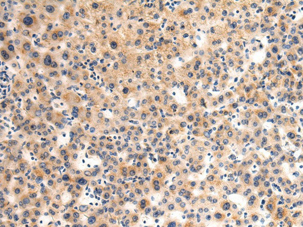 Immunohistochemistry of paraffin-embedded Human liver cancer tissue using GLT8D1 Polyclonal Antibody at dilution of 1:90(×200)
