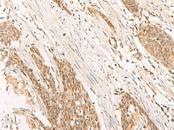 Immunohistochemistry of paraffin-embedded Human esophagus cancer tissue using POP4 Polyclonal Antibody at dilution of 1:65(×200)