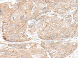 Immunohistochemistry of paraffin-embedded Human esophagus cancer tissue using SNRNP25 Polyclonal Antibody at dilution of 1:65(×200)