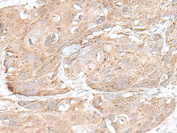 Immunohistochemistry of paraffin-embedded Human esophagus cancer tissue using SNRNP25 Polyclonal Antibody at dilution of 1:65(×200)