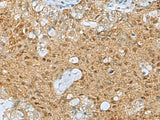 Immunohistochemistry of paraffin-embedded Human ovarian cancer tissue using PTPA Polyclonal Antibody at dilution of 1:60(×200)
