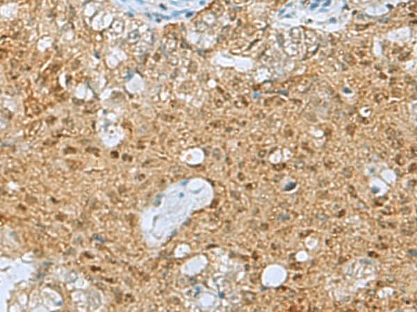 Immunohistochemistry of paraffin-embedded Human ovarian cancer tissue using PTPA Polyclonal Antibody at dilution of 1:60(×200)