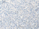 Immunohistochemistry of paraffin-embedded Human cervical cancer tissue using STAU2 Polyclonal Antibody at dilution of 1:45(×200)