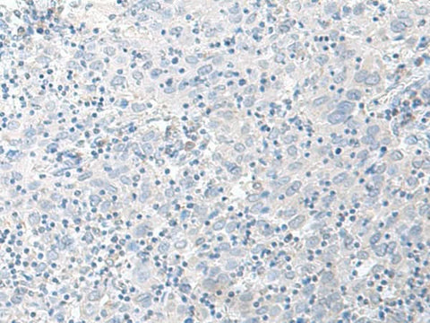 Immunohistochemistry of paraffin-embedded Human cervical cancer tissue using STAU2 Polyclonal Antibody at dilution of 1:45(×200)