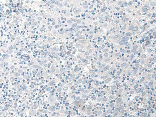 Immunohistochemistry of paraffin-embedded Human cervical cancer tissue using STAU2 Polyclonal Antibody at dilution of 1:45(×200)