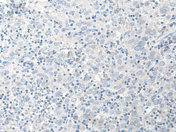 Immunohistochemistry of paraffin-embedded Human cervical cancer tissue using STAU2 Polyclonal Antibody at dilution of 1:45(×200)
