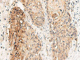 Immunohistochemistry of paraffin-embedded Human esophagus cancer tissue using GPR152 Polyclonal Antibody at dilution of 1:45(×200)