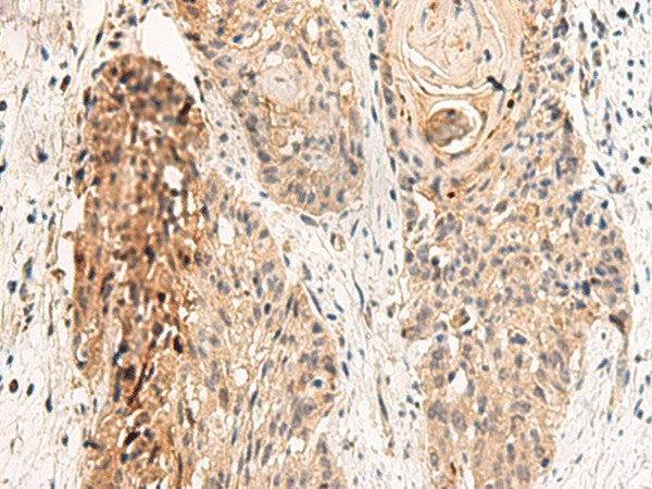 Immunohistochemistry of paraffin-embedded Human esophagus cancer tissue using GPR152 Polyclonal Antibody at dilution of 1:45(×200)