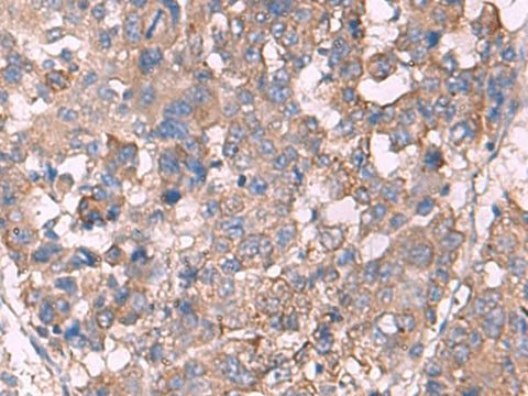 Immunohistochemistry of paraffin-embedded Human liver cancer tissue using KCNN3 Polyclonal Antibody at dilution of 1:60(×200)