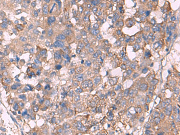 Immunohistochemistry of paraffin-embedded Human liver cancer tissue using KCNN3 Polyclonal Antibody at dilution of 1:60(×200)