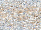 Immunohistochemistry of paraffin-embedded Human cervical cancer tissue using HLA-DRB3 Polyclonal Antibody at dilution of 1:50(×200)