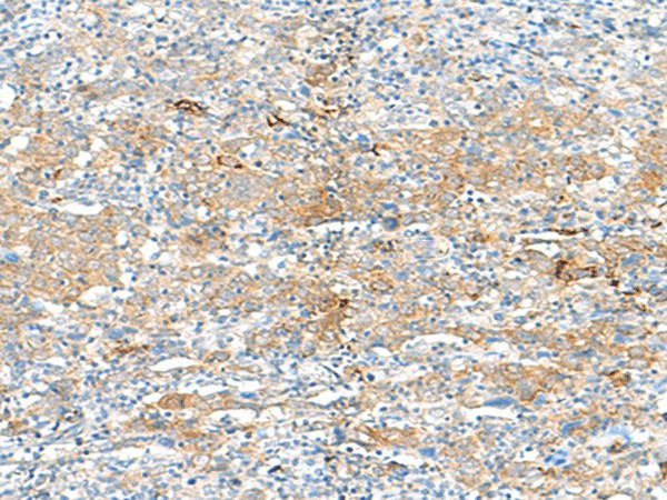 Immunohistochemistry of paraffin-embedded Human cervical cancer tissue using HLA-DRB3 Polyclonal Antibody at dilution of 1:50(×200)
