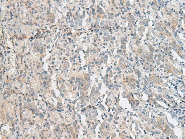 Immunohistochemistry of paraffin-embedded Human cervical cancer tissue using PCSK5 Polyclonal Antibody at dilution of 1:50(×200)
