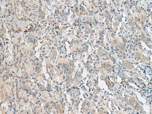 Immunohistochemistry of paraffin-embedded Human cervical cancer tissue using PCSK5 Polyclonal Antibody at dilution of 1:50(×200)