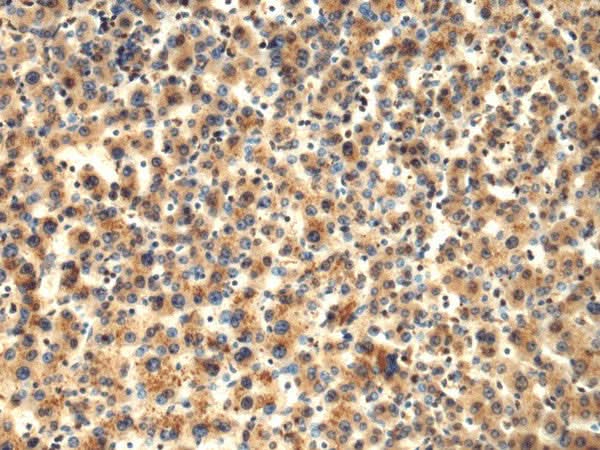 Immunohistochemistry of paraffin-embedded Human liver cancer tissue using TMOD1 Polyclonal Antibody at dilution of 1:65(×200)