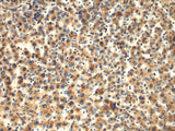 Immunohistochemistry of paraffin-embedded Human liver cancer tissue using TMOD1 Polyclonal Antibody at dilution of 1:65(×200)