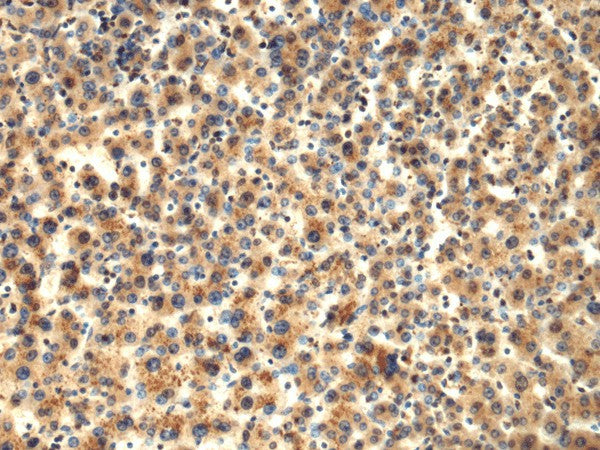 Immunohistochemistry of paraffin-embedded Human liver cancer tissue using TMOD1 Polyclonal Antibody at dilution of 1:65(×200)