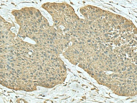 Immunohistochemistry of paraffin-embedded Human esophagus cancer tissue using FN3KRP Polyclonal Antibody at dilution of 1:55(×200)