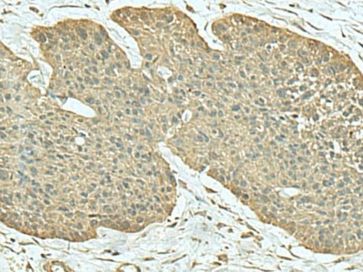 Immunohistochemistry of paraffin-embedded Human esophagus cancer tissue using FN3KRP Polyclonal Antibody at dilution of 1:55(×200)