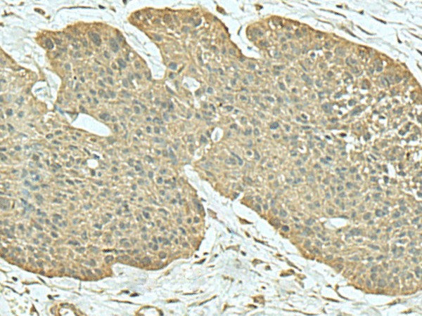 Immunohistochemistry of paraffin-embedded Human esophagus cancer tissue using FN3KRP Polyclonal Antibody at dilution of 1:55(×200)