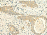 Immunohistochemistry of paraffin-embedded Human esophagus cancer tissue using MPV17 Polyclonal Antibody at dilution of 1:50(×200)