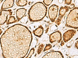 Immunohistochemistry of paraffin-embedded Human thyroid cancer tissue using LRRC2 Polyclonal Antibody at dilution of 1:55(×200)