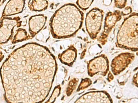Immunohistochemistry of paraffin-embedded Human thyroid cancer tissue using LRRC2 Polyclonal Antibody at dilution of 1:55(×200)