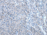 Immunohistochemistry of paraffin-embedded Human liver cancer tissue using ZIC1 Polyclonal Antibody at dilution of 1:65(×200)