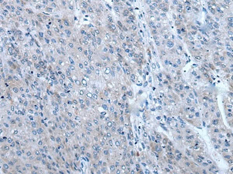 Immunohistochemistry of paraffin-embedded Human liver cancer tissue using ZIC1 Polyclonal Antibody at dilution of 1:65(×200)
