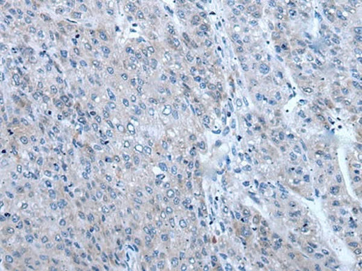 Immunohistochemistry of paraffin-embedded Human liver cancer tissue using ZIC1 Polyclonal Antibody at dilution of 1:65(×200)