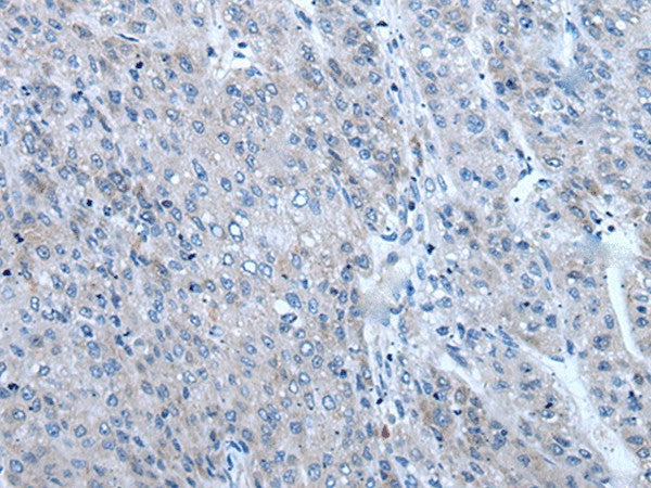 Immunohistochemistry of paraffin-embedded Human liver cancer tissue using ZIC1 Polyclonal Antibody at dilution of 1:65(×200)