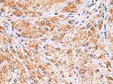Immunohistochemistry of paraffin-embedded Human liver cancer tissue using UXS1 Polyclonal Antibody at dilution of 1:60(×200)