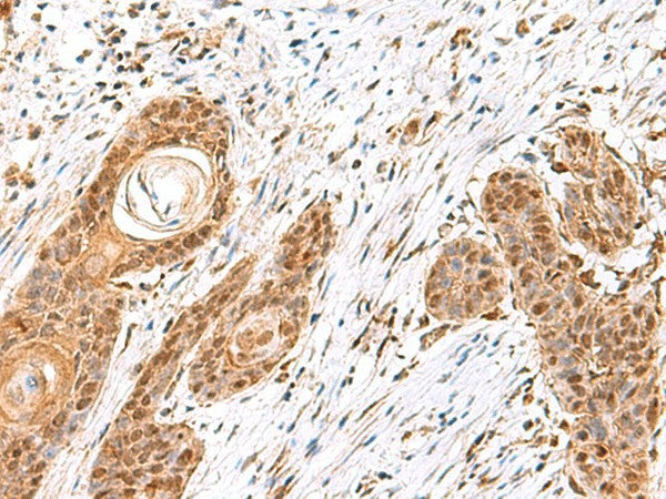 Immunohistochemistry of paraffin-embedded Human esophagus cancer tissue using MECR Polyclonal Antibody at dilution of 1:60(×200)