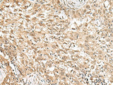 Immunohistochemistry of paraffin-embedded Human esophagus cancer tissue using RPS6KA5 Polyclonal Antibody at dilution of 1:160(×200)