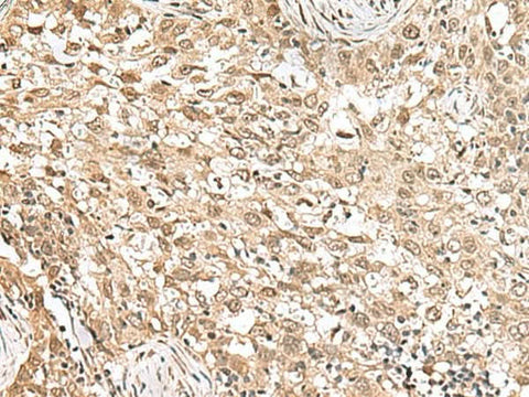 Immunohistochemistry of paraffin-embedded Human esophagus cancer tissue using RPS6KA5 Polyclonal Antibody at dilution of 1:160(×200)