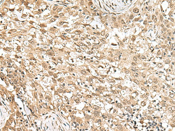 Immunohistochemistry of paraffin-embedded Human esophagus cancer tissue using RPS6KA5 Polyclonal Antibody at dilution of 1:160(×200)