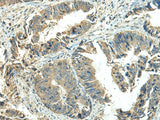 Immunohistochemistry of paraffin-embedded Human colorectal cancer tissue using NPVF Polyclonal Antibody at dilution of 1:65(×200)