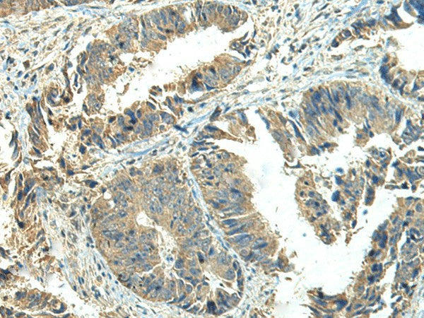 Immunohistochemistry of paraffin-embedded Human colorectal cancer tissue using NPVF Polyclonal Antibody at dilution of 1:65(×200)