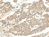 Immunohistochemistry of paraffin-embedded Human lung cancer tissue using GPR139 Polyclonal Antibody at dilution of 1:50(×200)