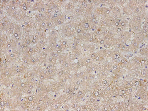 Immunohistochemistry of paraffin-embedded Human liver cancer tissue using RETN Polyclonal Antibody at dilution of 1:150(×400)