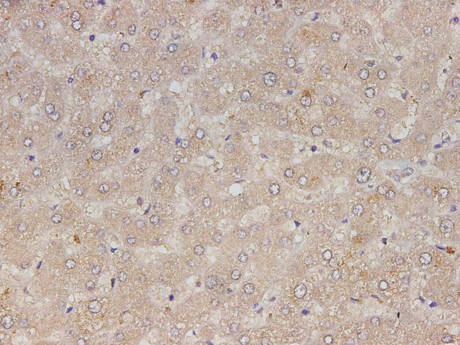 Immunohistochemistry of paraffin-embedded Human liver cancer tissue using RETN Polyclonal Antibody at dilution of 1:150(×400)